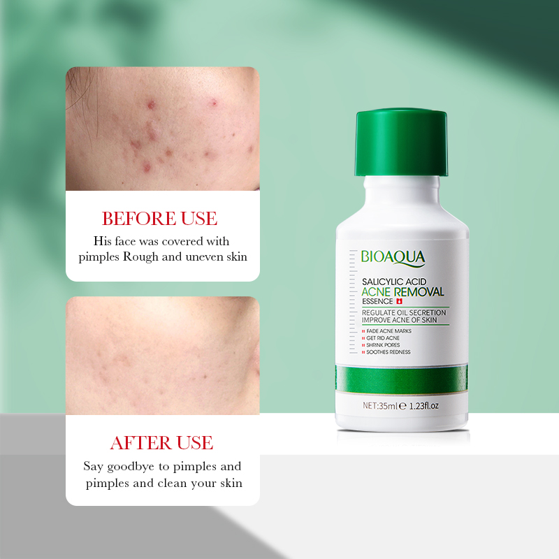 35ml BIOAOUA Salicylic Acid An - Azelaic Acid Serum のレビューと価格